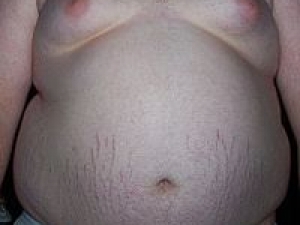 0_200px-central_obesity_008.jpg